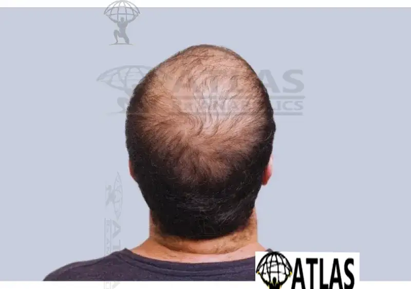 Hair Loss Medication Long Term Safety: Separating Real Risk from Fear